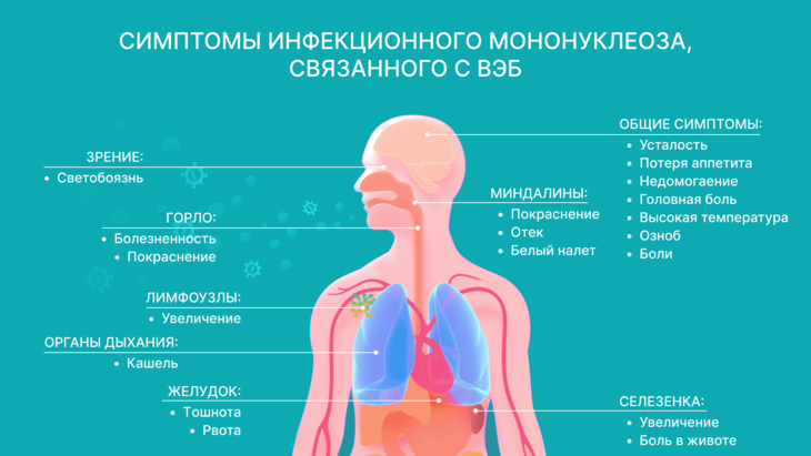 Инфекционный мононуклеоз