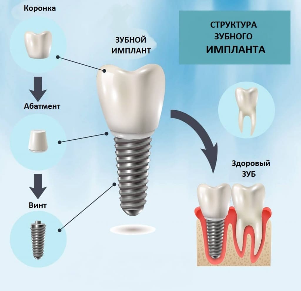 Имплантология в MAJOR CLINIC